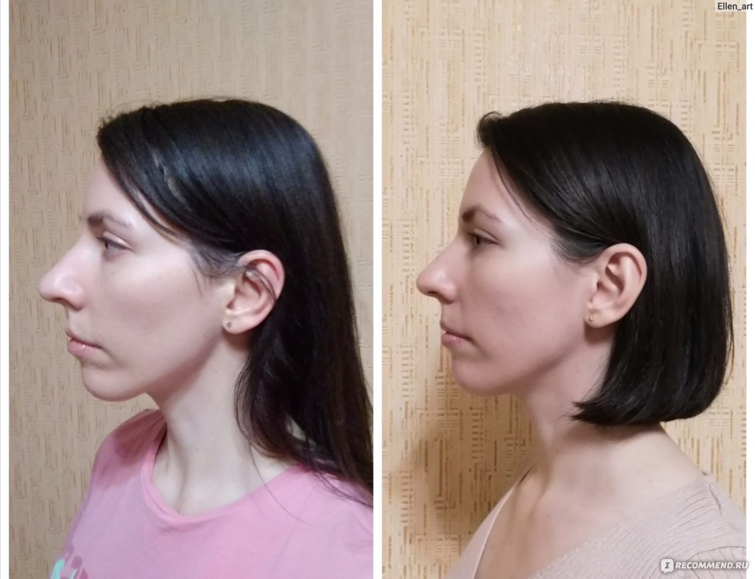Best Non-Surgical Facelift for Jowls: Your Complete Guide