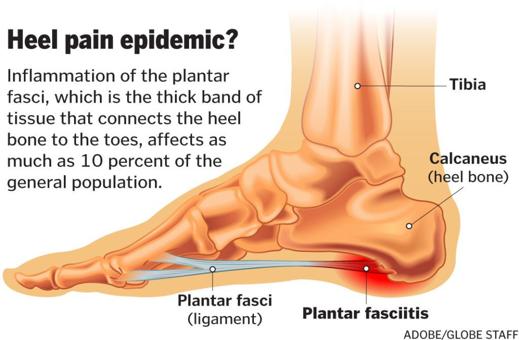 Reasons to Consult a Plantar Fasciitis Doctor at First Heel Pain
